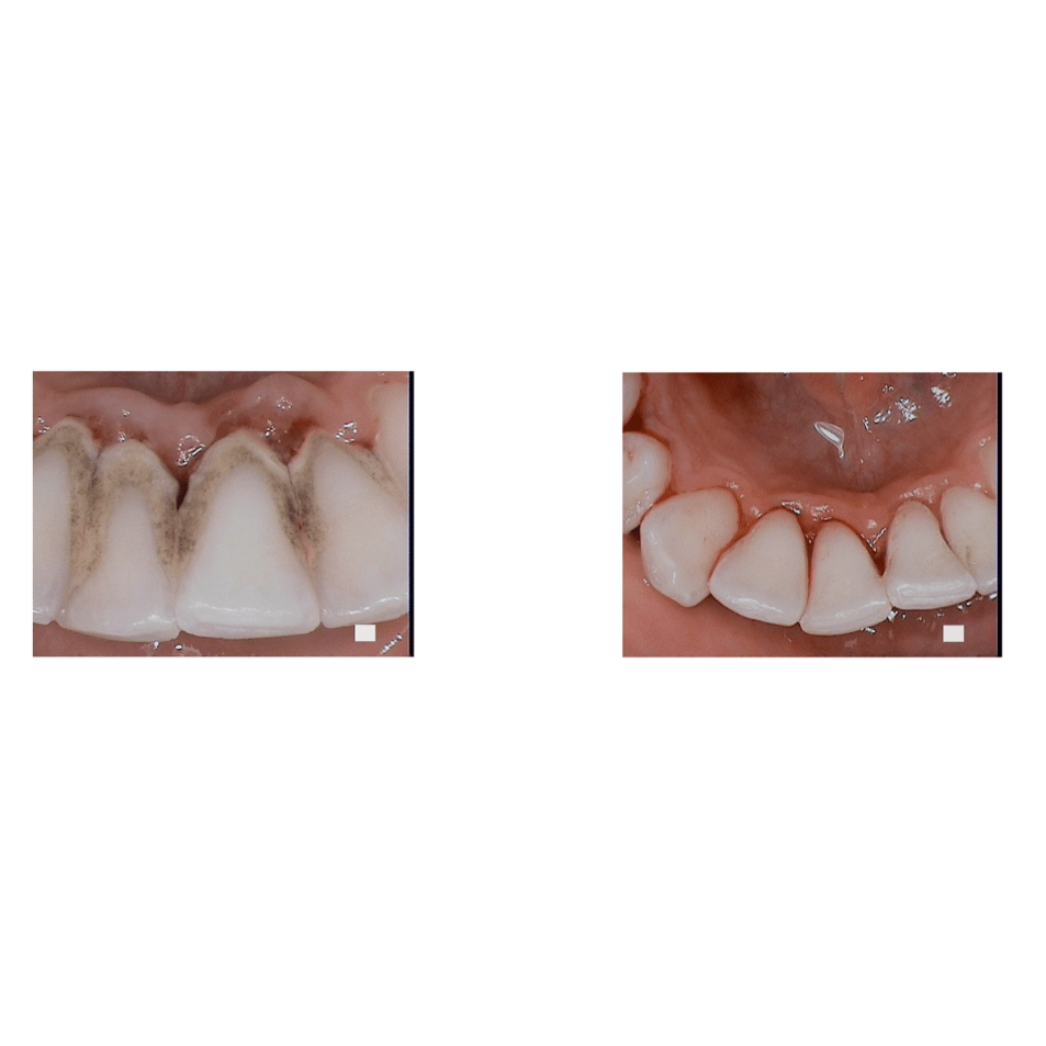 Scaling and Root PlaningWhat you need to know.